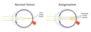 astigmatism
